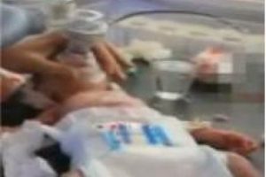Kafasında şarapnel par&ccedil;asıyla doğdu