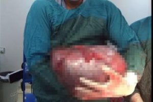 Karnından bebekle birlikte dev bir kitle &ccedil;ıkarıldı!