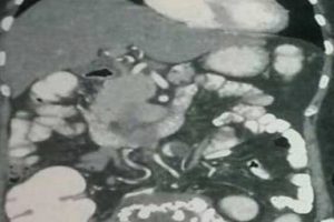36 yıllık bebek iskeleti annesinin karnından &ccedil;ıkarıldı!
