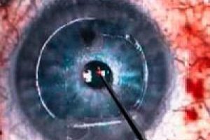 Okuma g&ouml;zl&uuml;ğ&uuml;n&uuml; tarihe karıştıracak implant!