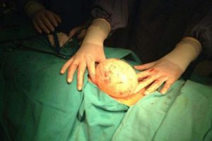 Suriyeli kızın karnından 1 kiloluk kist &ccedil;ıkartıldı