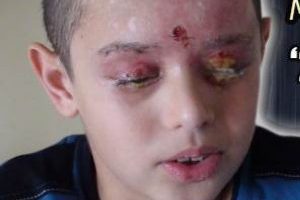 Okul deneyinde yaralanan Mert ameliyat oldu