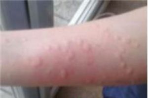 Kimsenin bilmediği bu hastalık soğukla ortaya &ccedil;ıktı