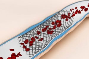 Şah damarına stent takıldı
