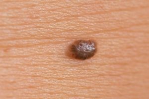 Benlerde "&ccedil;irkin &ouml;rdek" belirtisine dikkat !