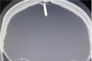 Kafatasında 2,5 santimlik &ccedil;iviyle yaşadı