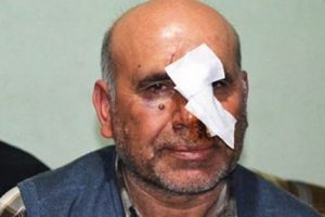 Testereyle burnu kesildi, 5 hastane dolaştı, tedavi olamadı