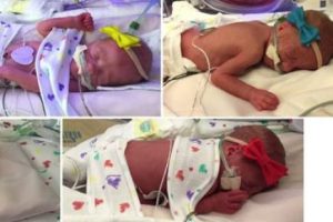 ABD'de tarihinde ilk beşiz kız bebek