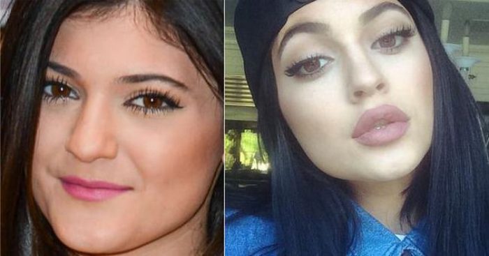 Kylie Jenner dudaklarının sırrını a&ccedil;ıkladı...