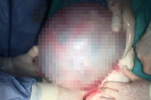 Bursa'da bir kadının rahminden 5 kiloluk kist &ccedil;ıktı!