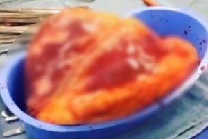 Kokain bağımlısından &ccedil;ıkarılan kalp tam 25 dakika attı!