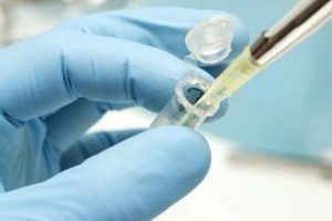 Pankreas kanserinin erken teşhisinde &ouml;nemli gelişme