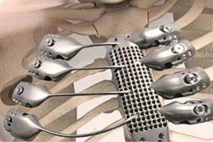 3D yazıcıda &uuml;retilen g&ouml;ğ&uuml;s kafesi nakledildi