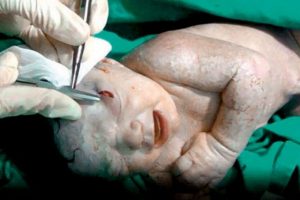 Şok! Bebek başında şarapnel par&ccedil;asıyla doğdu!