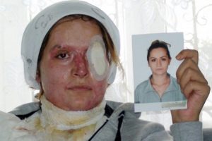 Kocasının kezzapla bu hale getirdiği kadın yardım bekliyor