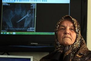 Yaşlı kadın karnında unutulan makasla 5 yıl yaşadı!