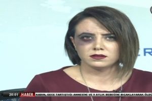 Canlı yayına morarmış g&ouml;zle &ccedil;ıktı