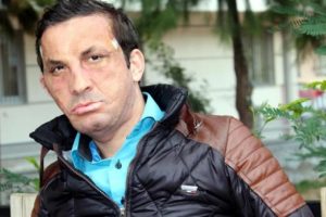 İlk y&uuml;z nakli olan Uğur Acar, gripten hastanede