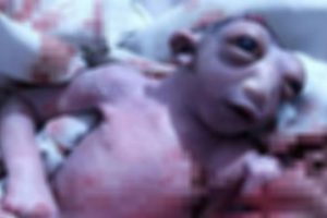 Başının bir kısmı olmadan d&uuml;nyaya gelen bebek hayatını kaybetti