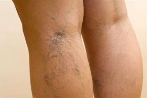 Kadınlarda sık&ccedil;a g&ouml;r&uuml;len varis erkeklerinde sorunu