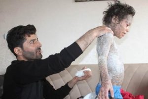 K&uuml;&ccedil;&uuml;k Melih'in dramı y&uuml;rek burkuyor