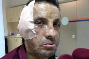 İlk y&uuml;z nakilli Uğur Acar'a, estetik m&uuml;dahale