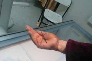 Suriyeli kadının eline batan oya iğnesi operasyonla &ccedil;ıkarıldı