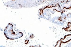 Alzheimer'a implantlı tedavi