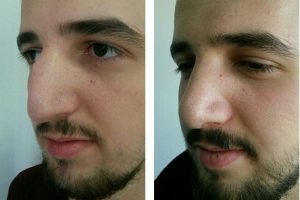 Sağlıklı nefes i&ccedil;in sağlıklı burun