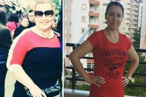 T&uuml;p mide ameliyatıyla 8 ayda 40 kilo verdi