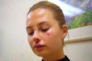 Chloe Loughnan kaza sonrası bu hale geldi!