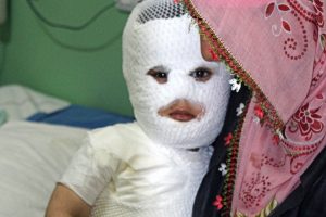S&uuml;t kazanına d&uuml;şen &ccedil;ocuk feci şekilde yandı