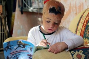 Evlerine d&uuml;şen bombayla y&uuml;z&uuml; par&ccedil;alanan Suriyeli Evin'in dramı