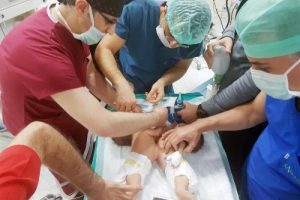 Şanlıurfa'da yapışık ikizler ameliyatla ayrıldı