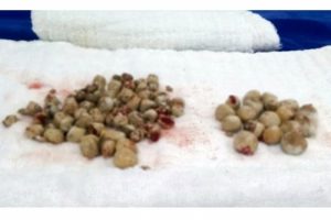 Doktorları bile şaşırtan b&ouml;brek taşları