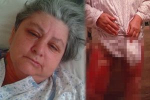 Bursa'da ameliyatta bacakları yanan kadın 1 yıl &ouml;zel elbise giyecek