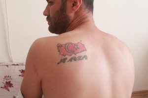 D&ouml;vme y&uuml;z&uuml;nden bir hafta işkence g&ouml;rd&uuml;!