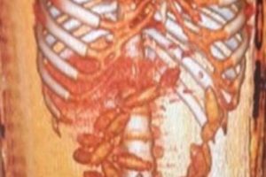 Sindirim sistemlerinden uyuşturucu &ccedil;ıktı