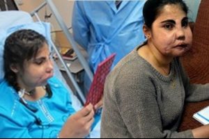 T&uuml;rkiye'nin y&uuml;z nakli yapılan ilk kadını Hatice Nergis &ouml;ld&uuml;