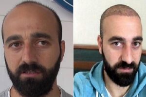 Sa&ccedil; ektiren futbolcunun s&ouml;zleşmesi feshedildi!