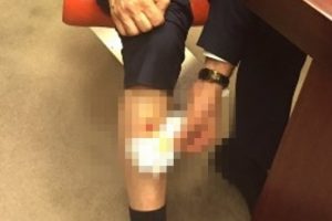 AK Partili vekili bacağından ısırdılar