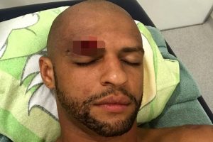 Felipe Melo'nun kaşı a&ccedil;ıldı