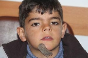 &Ccedil;enesindeki t&uuml;m&ouml;rle 7 yıl yaşamıştı tedavi oldu