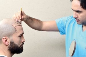 Sa&ccedil; ekiminde sa&ccedil; &ccedil;izgisine dikkat