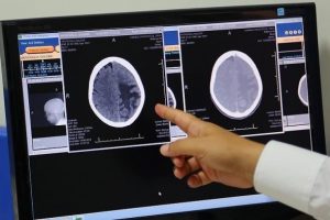 Beyin h&uuml;crelerinin yeniden programlanması Parkinson'a &ccedil;are olabilir