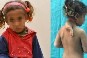 Minik kızın 3'&uuml;nc&uuml; kolu ameliyatla alındı