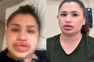 "Estetik" mağduru hemşire taburcu edilecek