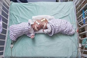 Siyam ikizleri 11 saatte birbirinden ayrıldı