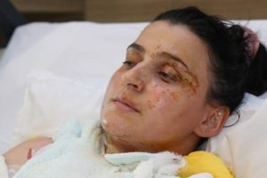 Jel yakıt anne-kızı hastanelik etti