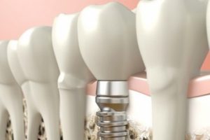 Diş eksikliğine dikişsiz implant alternatifi